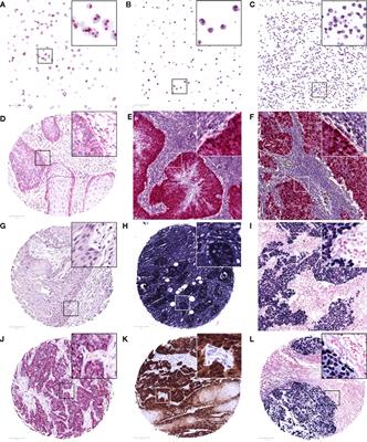 Papilloma vírus ember tumor Fertőző vírusok a daganatok hátterében